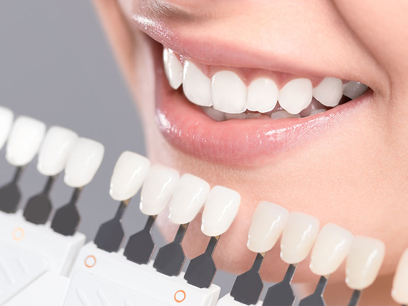 牙齒美白