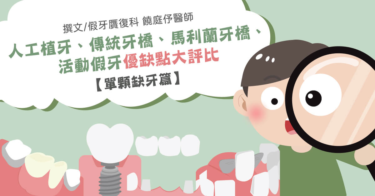 缺牙有影響嗎？人工植牙、傳統牙橋、活動假牙優缺點大評比