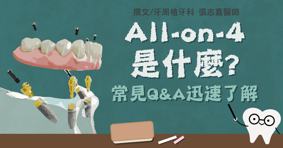 All-on-4 是什麼？比全口植牙更便宜？Q&A看這篇！