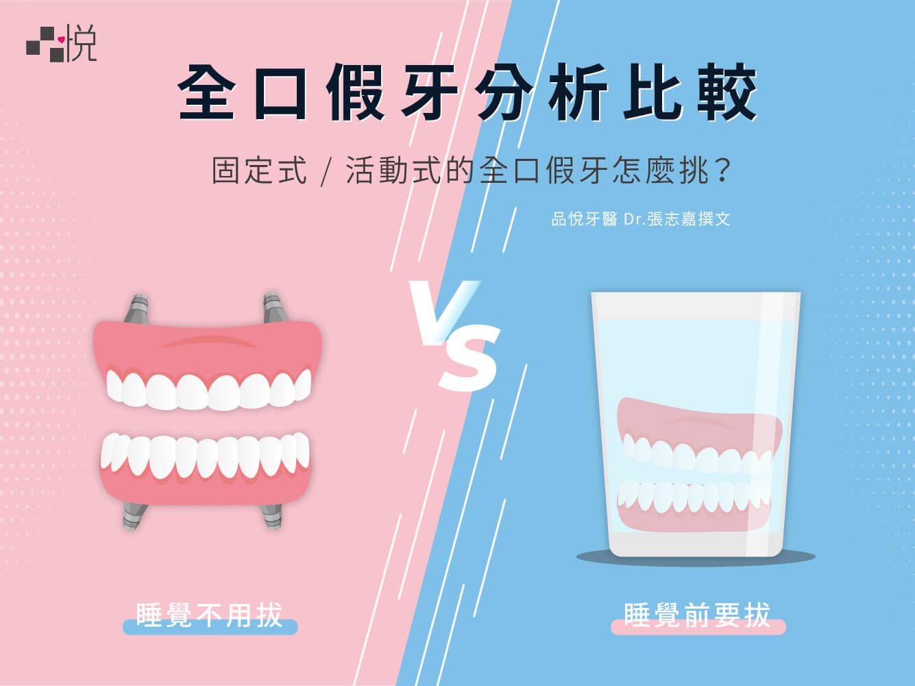 【全口缺牙重建】活動式假牙、固定式假牙All-on-4的五大差異