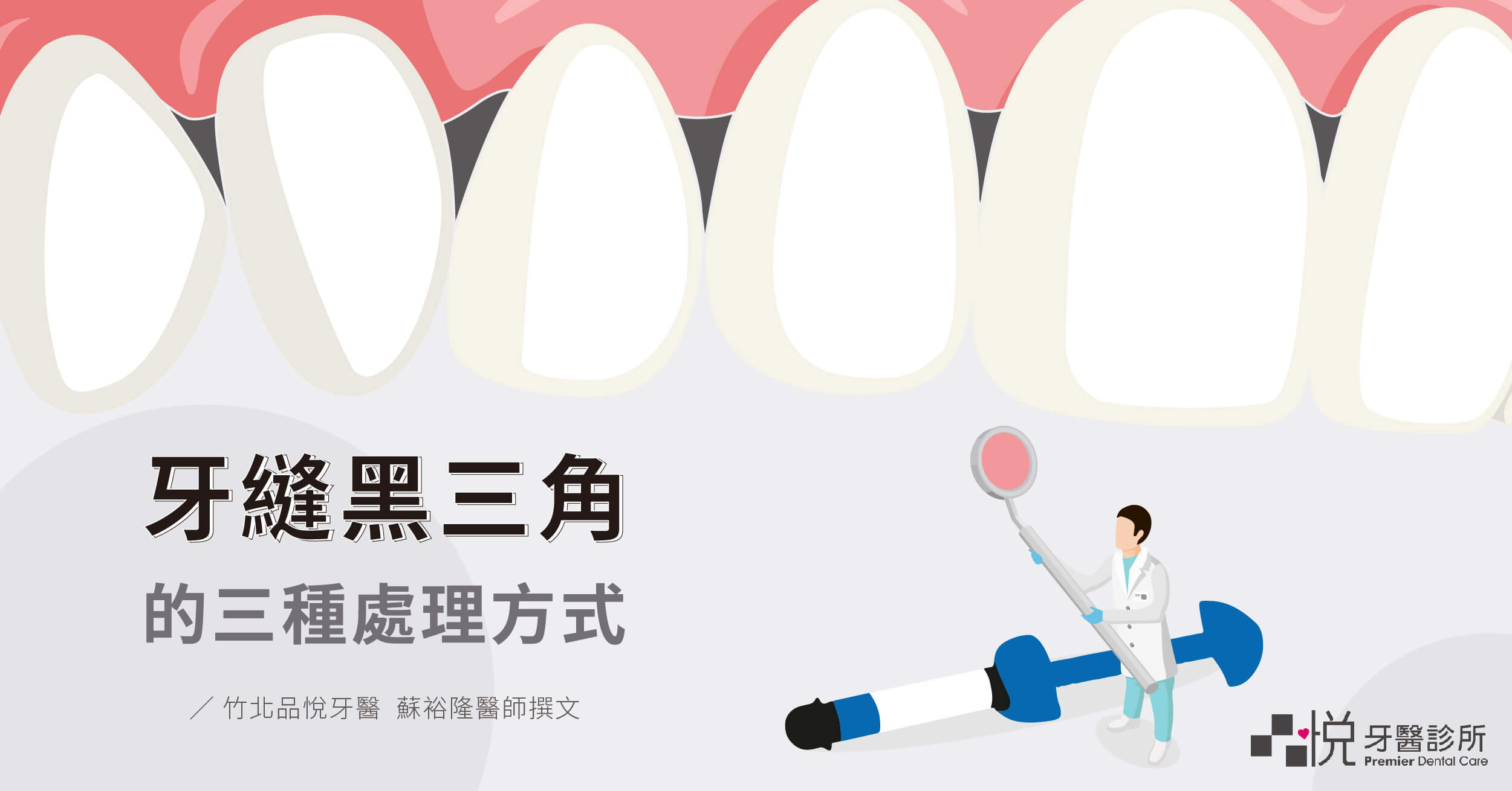【矯正後黑三角縫】陶瓷貼片、美學樹脂改善牙縫黑三角案例分析