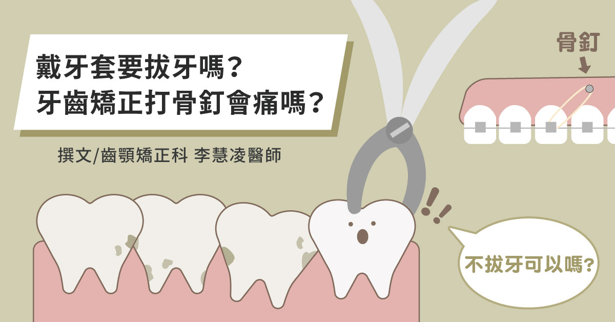 戴牙套要拔牙嗎？牙齒矯正打骨釘會痛嗎？【竹北牙齒矯正推薦】