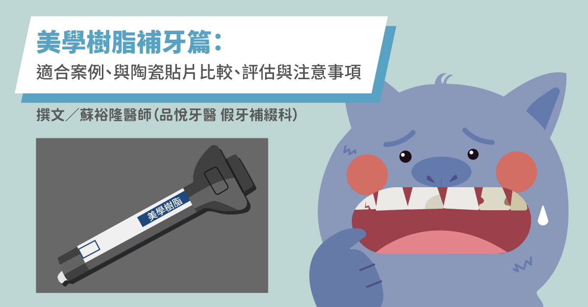 【美學樹脂補牙篇】適合案例、與陶瓷貼片比較、評估與注意事項