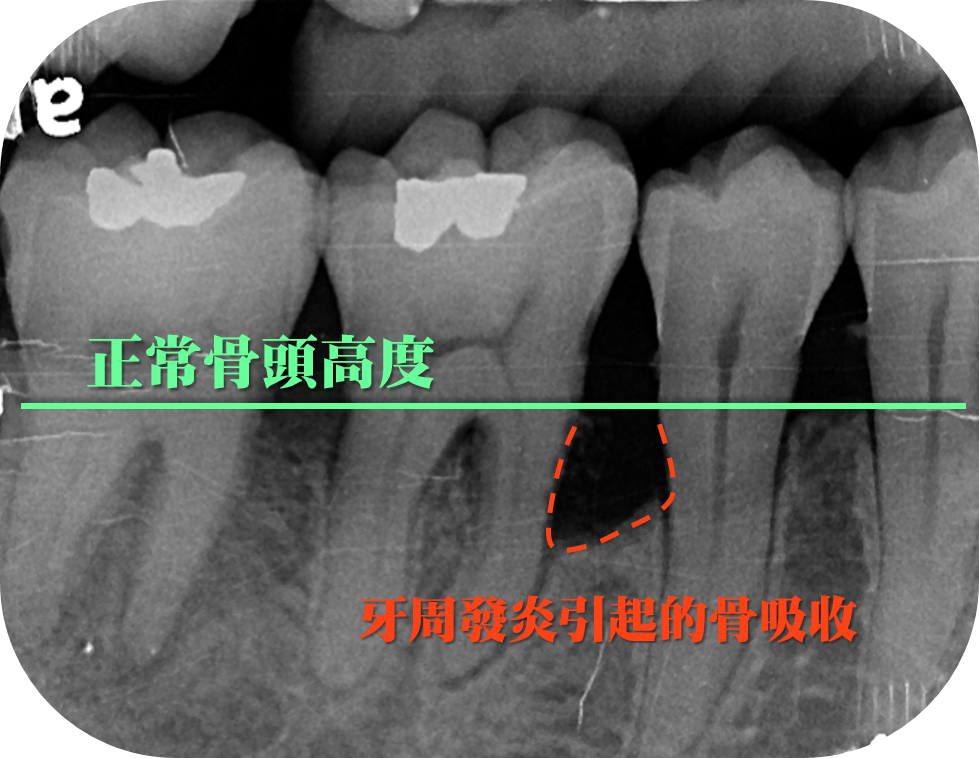 X光片可以看到牙周發炎引起的骨吸收