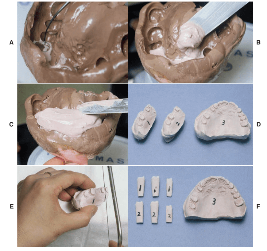 傳統牙科灌模步驟