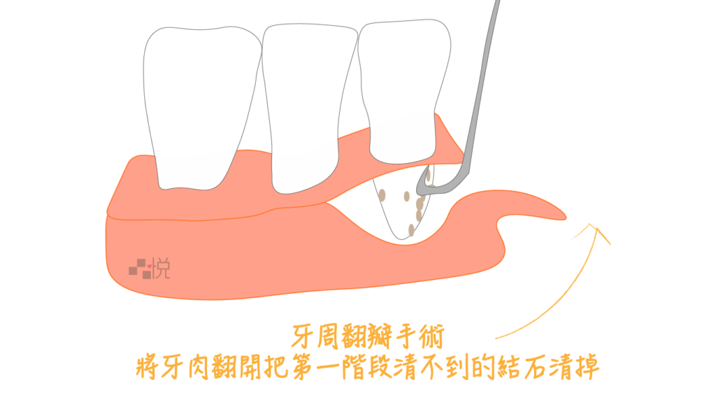 竹北牙周翻瓣手術