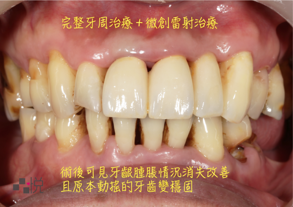 牙周病微創治療後牙齦的腫脹情況改善