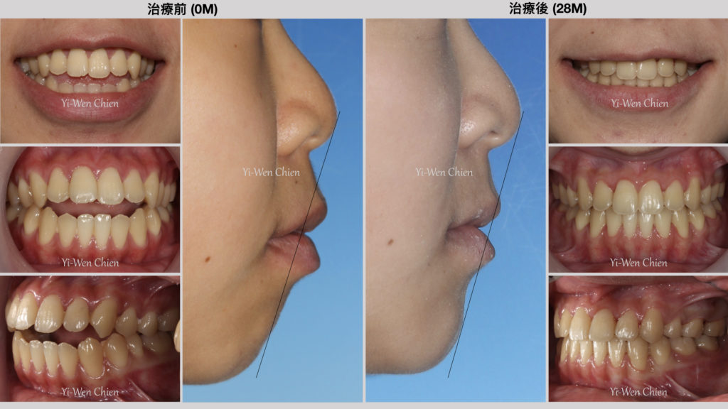 牙齒治療暴牙改善長型臉前後比較