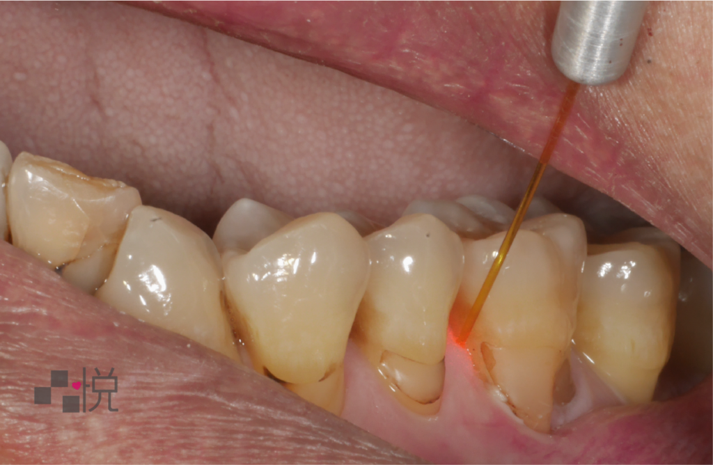 雷射光深沉清潔牙周病的牙結石