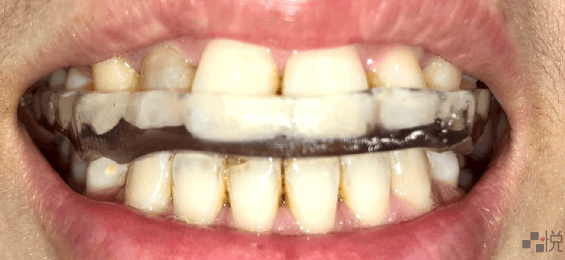 上下顎之間透明的物體為咬合板