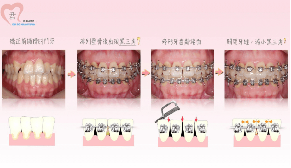 用牙齒矯正和磨牙填補黑三角