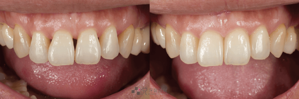 高級奈米美學樹脂填補黑三角案例照片