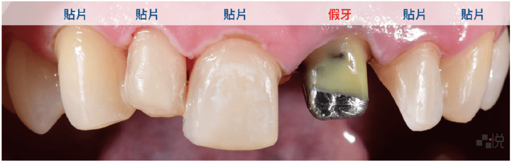 陶瓷貼片磨牙後遺症