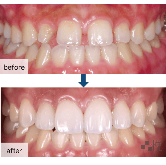 新竹陶瓷貼片術前術後
