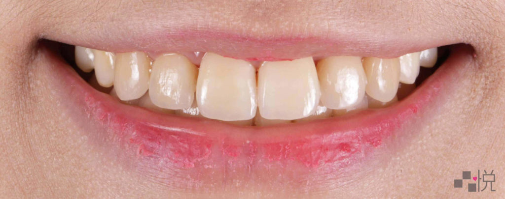 陶瓷貼片正式裝戴後AA2