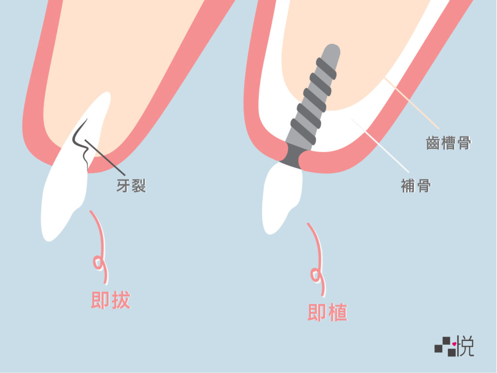 即拔即植剖面圖