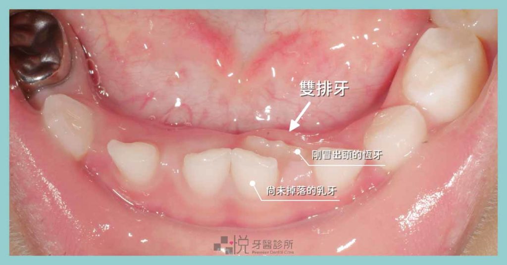 兒童乳牙換牙過渡期的雙排牙照片,乳牙掉不下來,恆牙長不出來