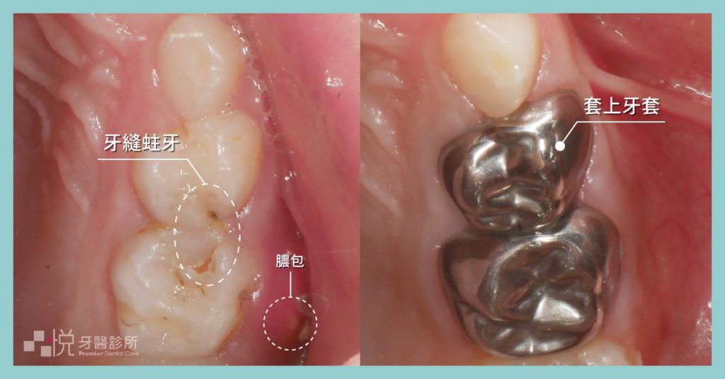 兒童乳牙蛀牙戴金屬牙套