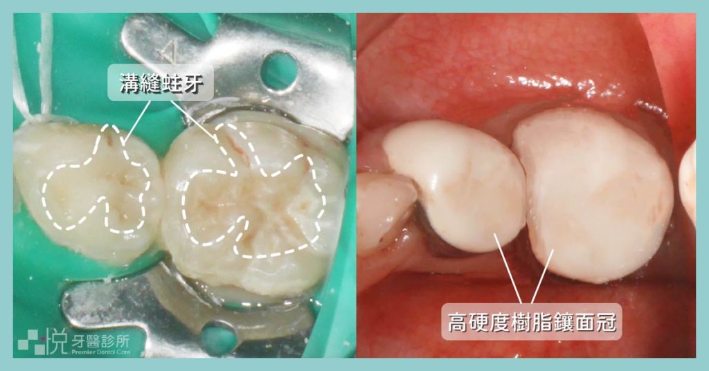 兒童蛀牙使用高硬度樹脂補牙