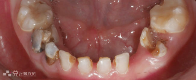 新竹兒童下顎嚴重蛀牙