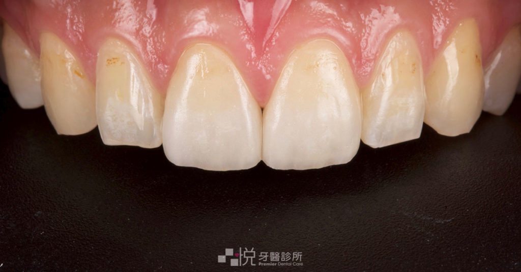 竹北陶瓷貼片正式裝戴術後案例