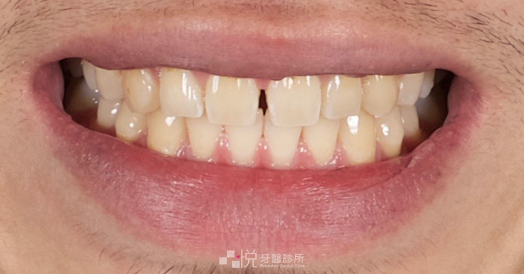 竹北陶瓷貼片美容前