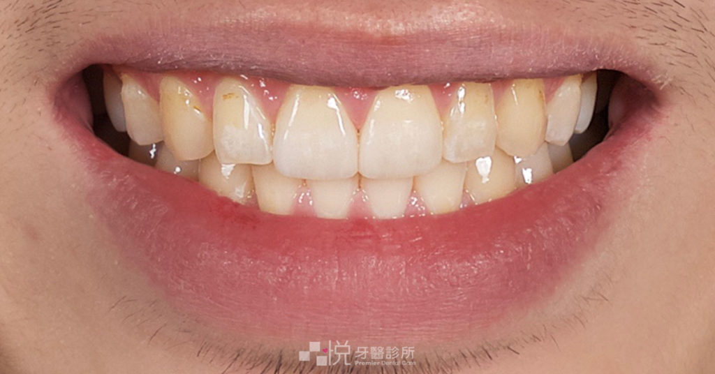 竹北陶瓷貼片術後復原狀況