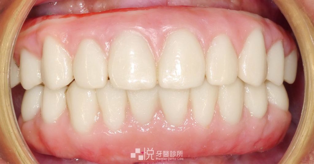 All on 4 手術後裝上假牙