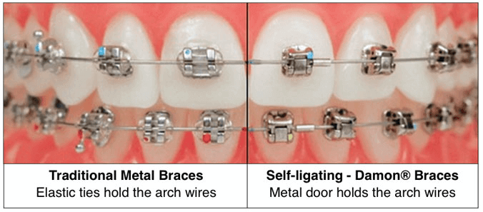 傳統矯正與戴蒙矯正器的差異