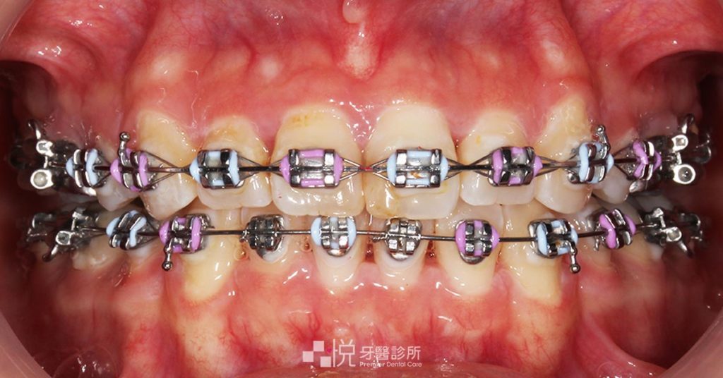 竹北傳統矯正綁橡皮筋正面照片