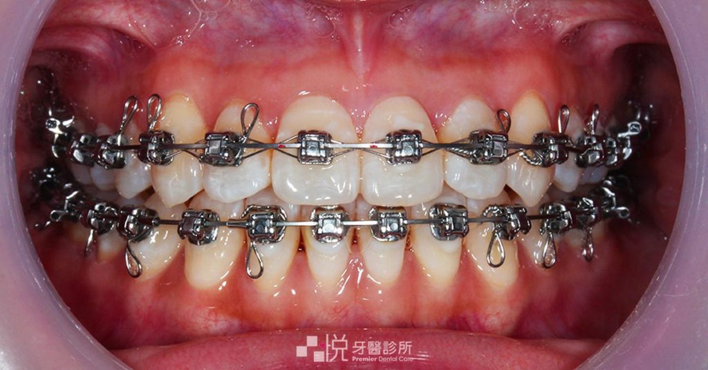 竹北戴蒙金屬矯正器正面照片