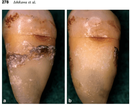 水雷射牙根術前跟術後