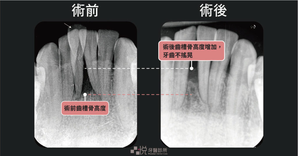 水雷射後牙齦增高