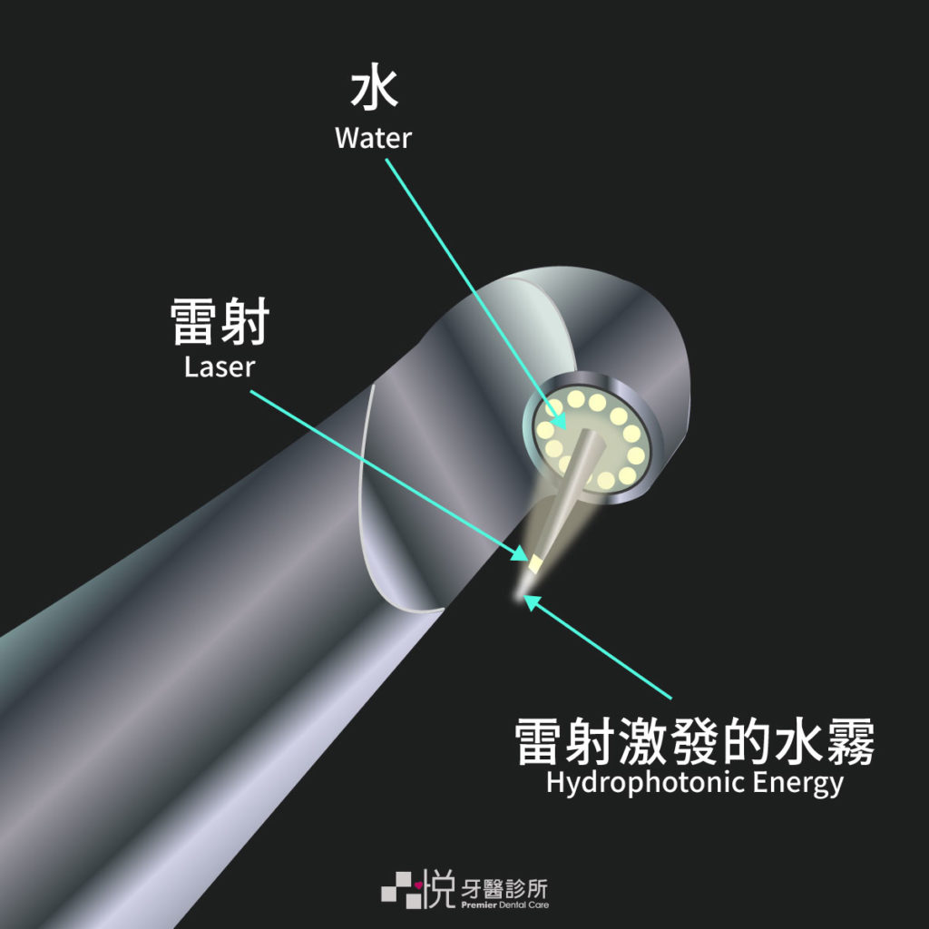 牙周水雷射的鑽頭有：水、光、雷射激發的水霧