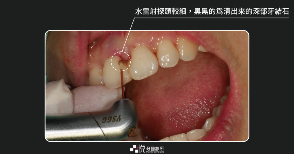 水雷射的探頭細細地伸進牙周囊袋裡