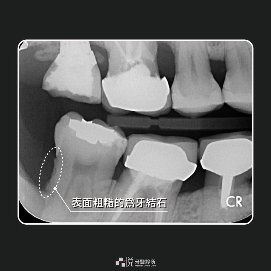透過Ｘ光看到牙齦下粗糙的牙結石