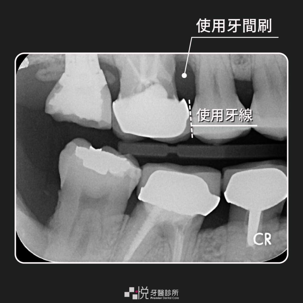 從Ｘ光看牙縫大小