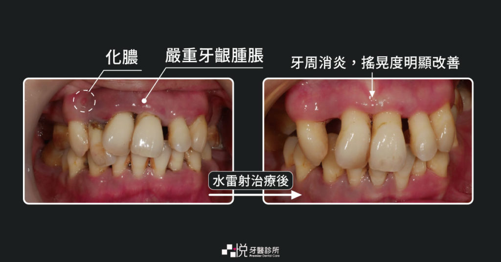 水雷射牙周治療後牙齒不搖晃的照片