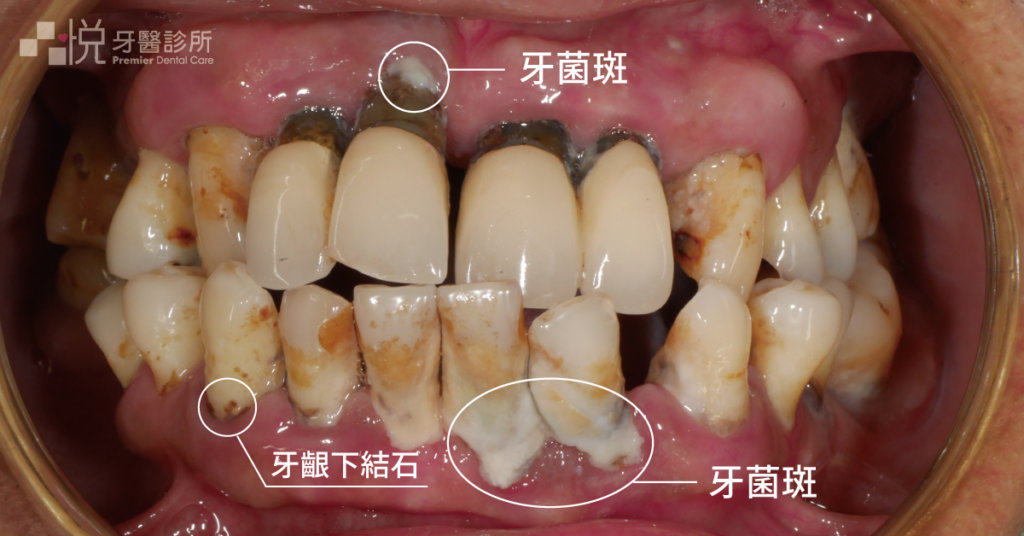 牙菌斑就是引起牙周病的元兇，如果牙菌斑沒有及時被清除，久了就會成為牙結石。