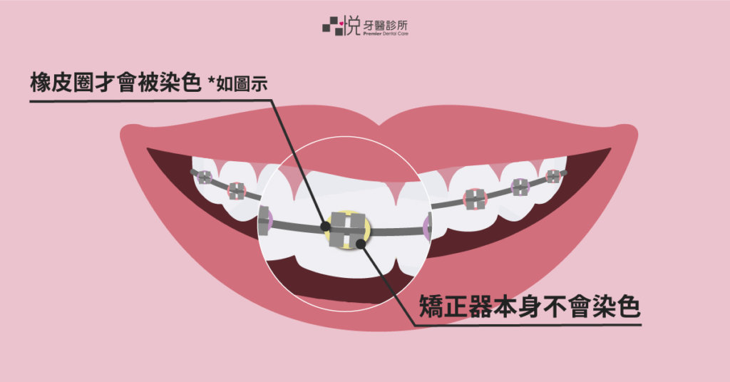 金屬及陶瓷的矯正器基本不需擔心會有染色問題，而橡皮材質就需避免吃到顏色過深的食物。