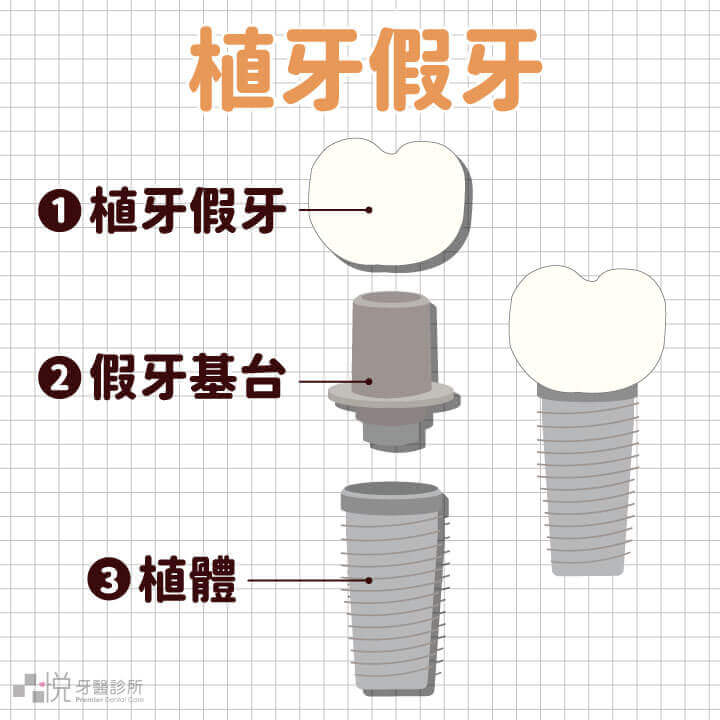 植牙假牙分為三部分:植牙假牙、假牙基台、植體