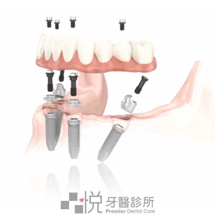 All-on-4 圖片來源:諾保科提供