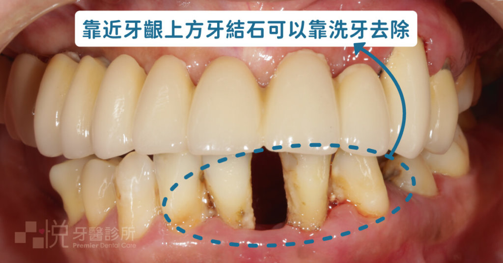 靠近牙齦上方的牙結石可以依靠洗牙去除