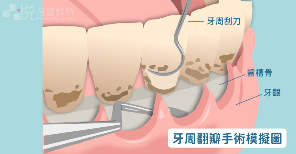 牙周翻瓣手術：是透過手術翻開部分牙齦，讓醫師可以因為視野更清楚將牙根附近的牙結石及發炎組織清除得更徹底。