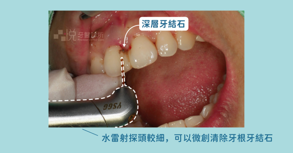 水雷射治療牙周病：不需要翻開牙齦也可以清除牙根處的牙結石與發炎組織。