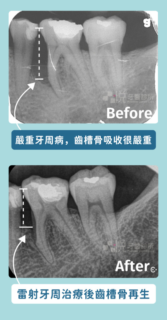 雷射治療後齒槽骨再生，讓牙齒不像之前那樣搖晃。
案例提供：張真豪醫師 品悅牙醫