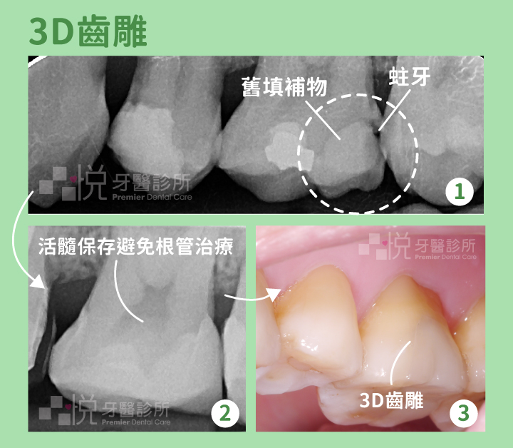 ➊ 舊樹脂填補物下二度蛀牙
➋ 活隨保存術保護牙髓組織
➌ 3D齒雕保護局部缺損牙齒
案例提供:林家丞醫師 品悅牙醫