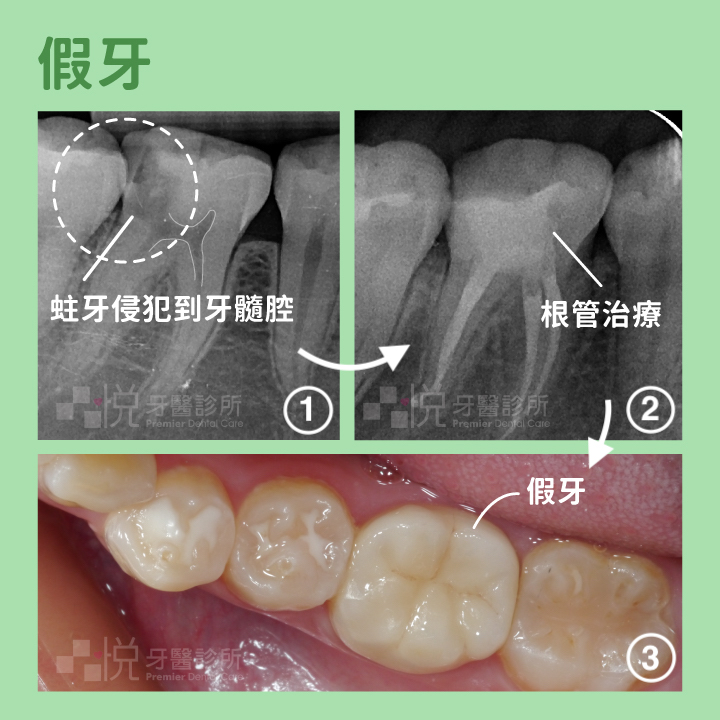 (左上)深度蛀牙已經侵犯牙髓腔
(右上)進行根管治療
(下)套上牙冠套以保護剩下齒質
案例提供:林家丞醫師 品悅牙醫