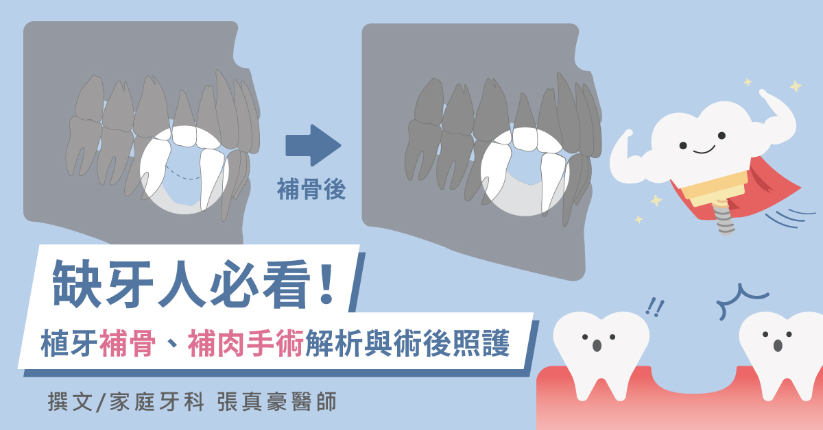 缺牙人必看！植牙補骨手術、補肉手術解析與術後照護一次看