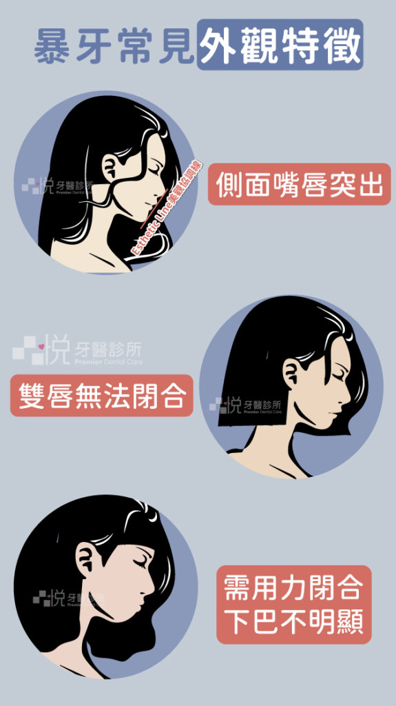 暴牙的常見特徵:
1.側臉輪廓上下嘴唇突出於美觀線 ( E-line:從鼻尖到下巴最突點的連線 ) 之外。
2.雙唇無法自然閉合。
3.上下唇要完全閉合必須用力,此動作將導致下嘴唇下方的肌肉出現皺折,下巴輪廓不明顯。